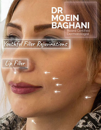 تزریق ژل لب