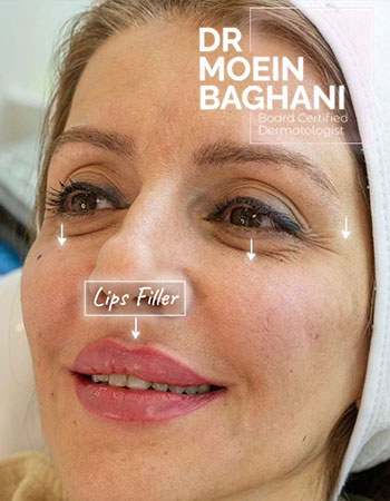 تزریق ژل لب در تهران