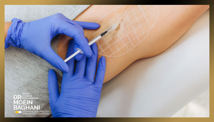 بوتاکس زیربغل