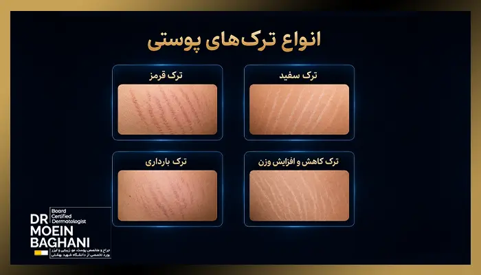 انواع ترک پوستی و درمان ترک پوستی